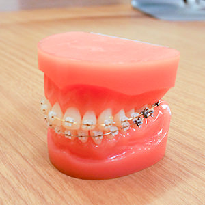 歯科矯正用アンカースクリューを用いた矯正(歯科)治療